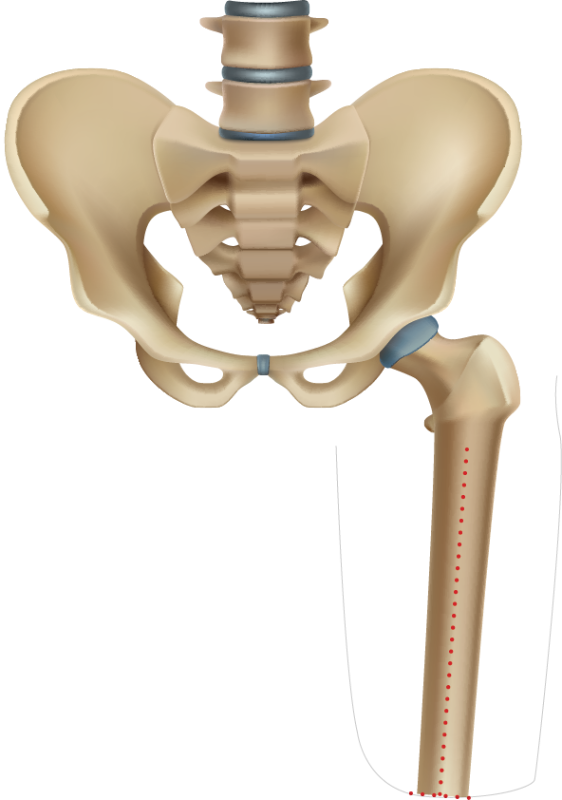 Femoral Preparation
