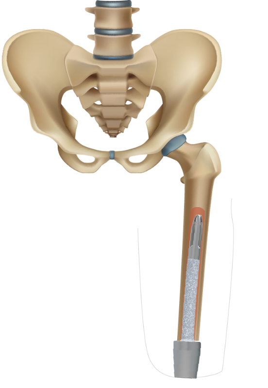 Implant Insertion