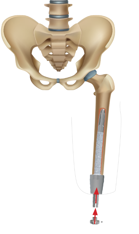 Insertion and assembly