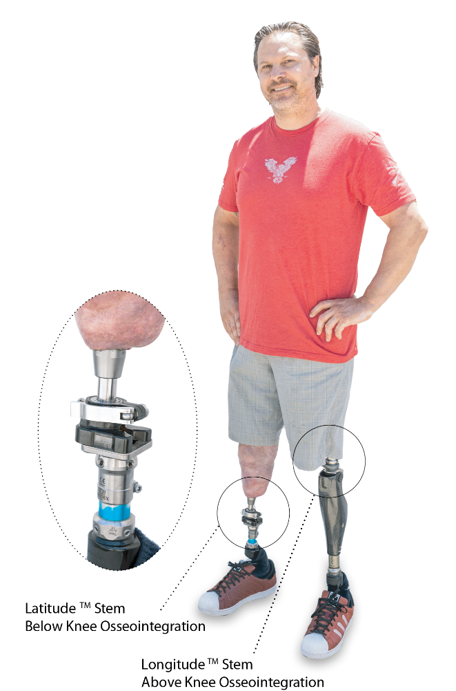 Osseointegration on patient