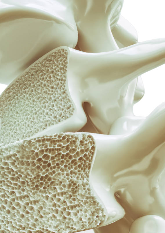 Osteoporosis on the spine – 3d rendering
